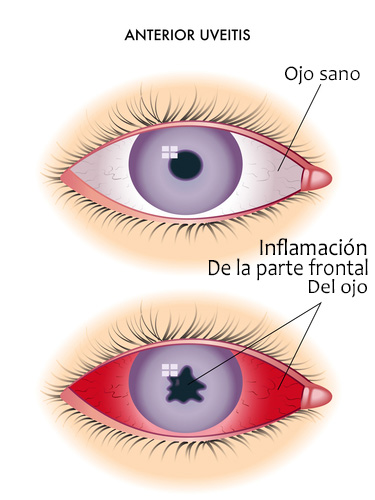LA TERAPIA PRECOZ MEJORA EL PRONÓSTICO DE UVEÍTIS